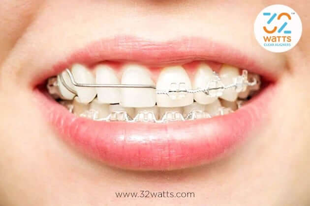 Do Braces Have Side Effects?  Disadvantages Of Wearing Teeth Braces