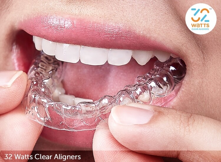 Clear Aligners Cost In Singapore  Best Invisible Braces In Singapore